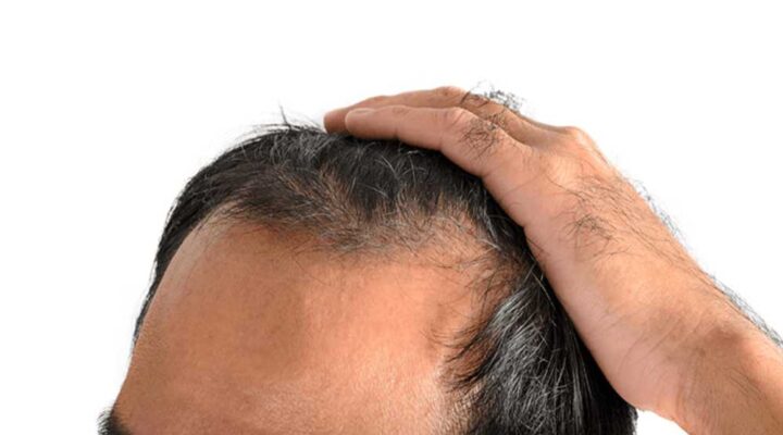 علاج الصلع