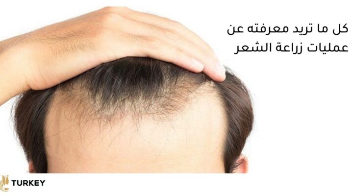 عملية زراعة الشعر