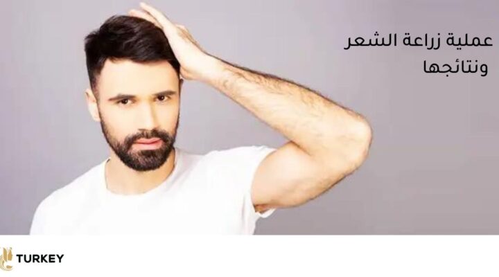 نتائج عملية زراعة الشعر