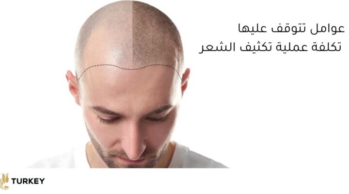 عوامل تتوقف عليها تكلفة عملية زراعة الشعر