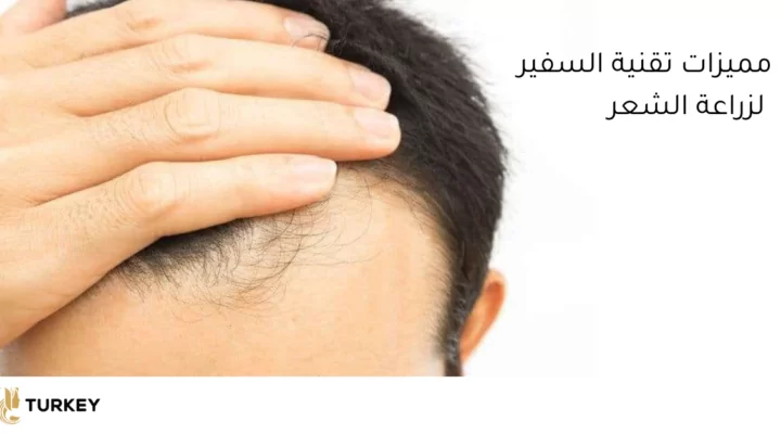 تقنية السفير لزراعة الشعر 2026