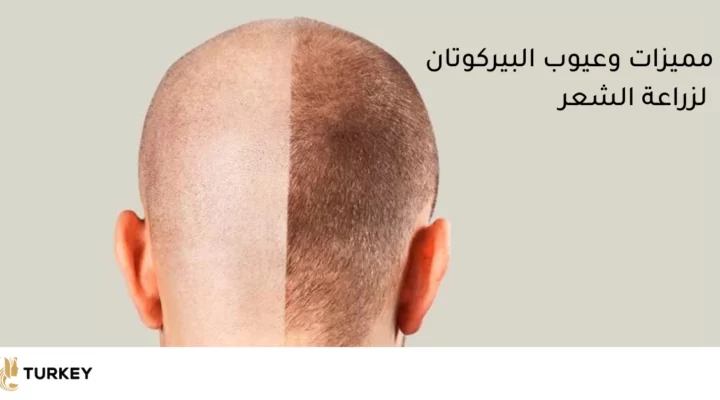 مميزات وعيوب تقنية البيركوتان لزرع الشعر