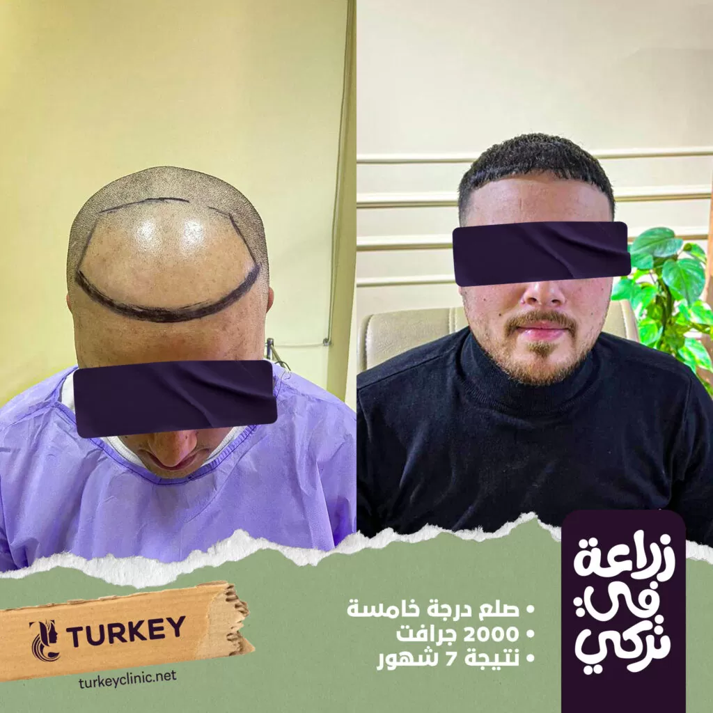 زراعة الشعر بالرياض | التقنيات والتكلفة العيوب والمميزات 4 نتيجة عملية زراعة الشعر بعد مرور 7 شهور