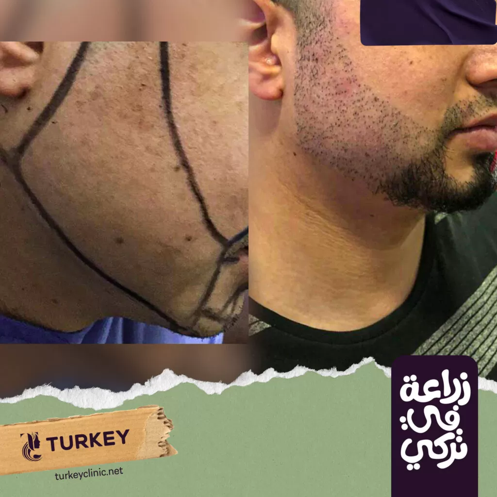 نتيجة تجربتي في زراعة شعر اللحية