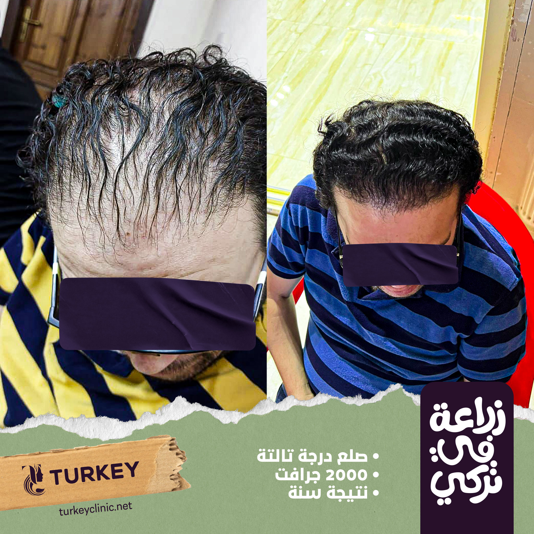 تجارب زراعة الشعر في مصر في مركز تركي هير