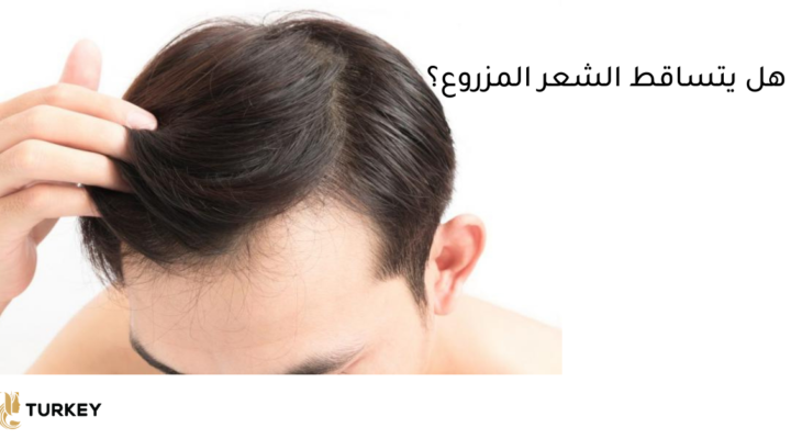 هل يتساقط الشعر بعد الزراعة؟