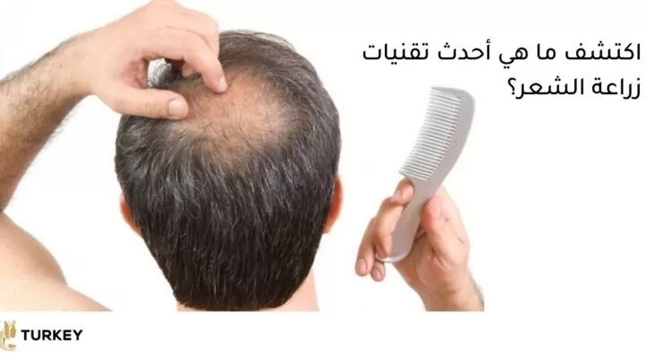 أفضل تقنيات زراعة الشعر
