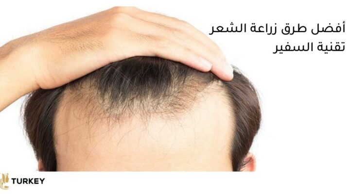 زراعة الشعر بتقنية السفير