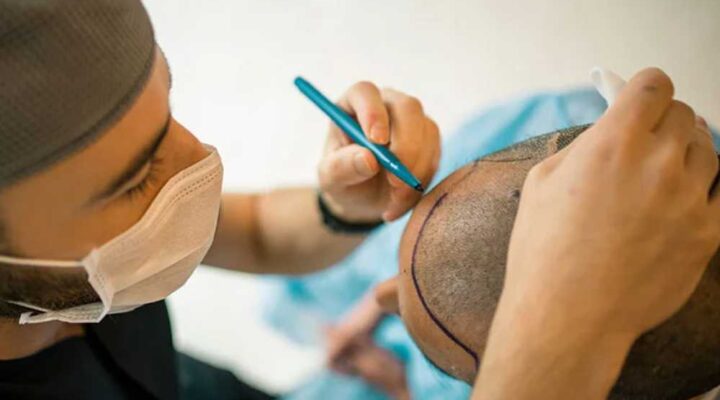 اخر تقنيات زراعة الشعر