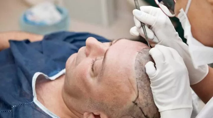 افضل تقنيات زراعة الشعر