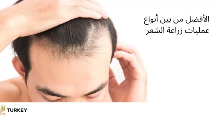 الأحدث من بين أنواع عمليات زراعة الشعر