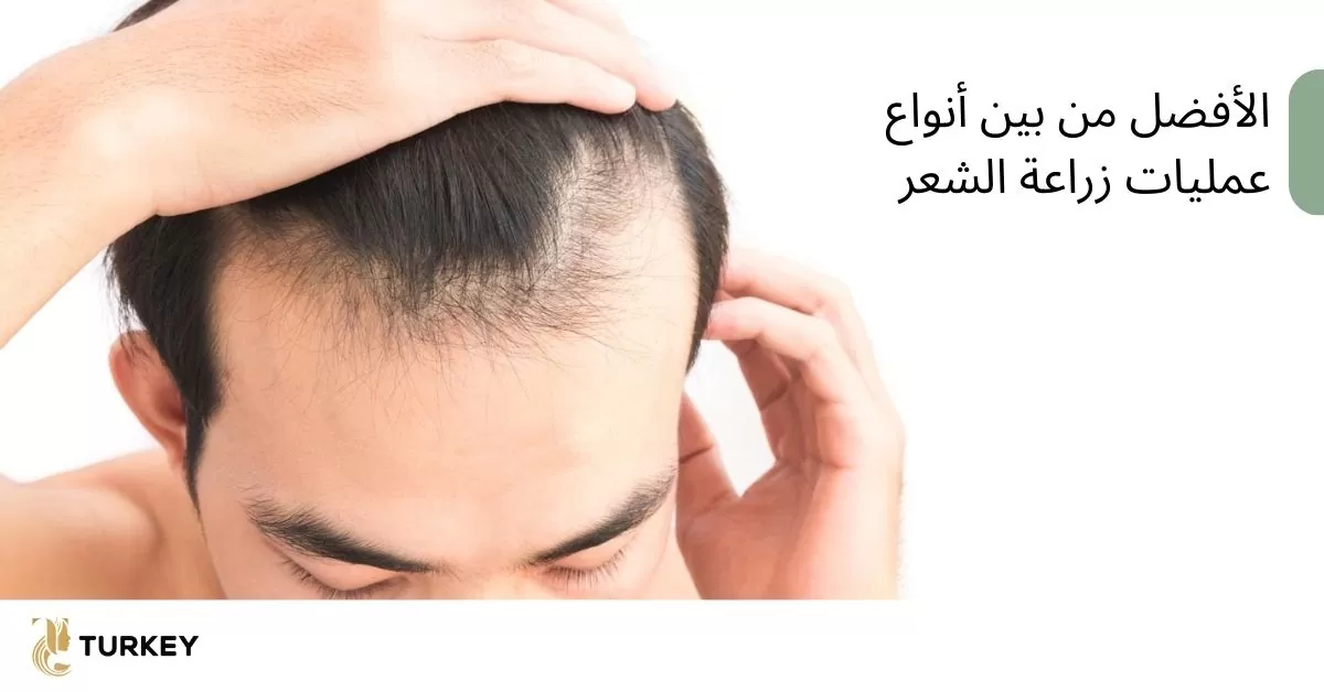 الأحدث من بين أنواع عمليات زراعة الشعر