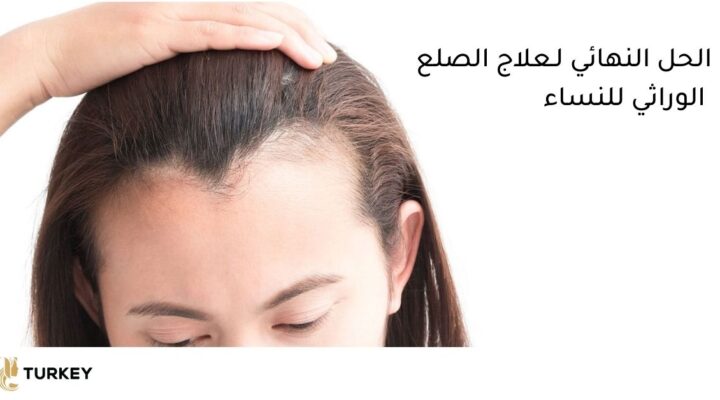 الحل النهائي لعلاج تساقط الشعر الوراثي