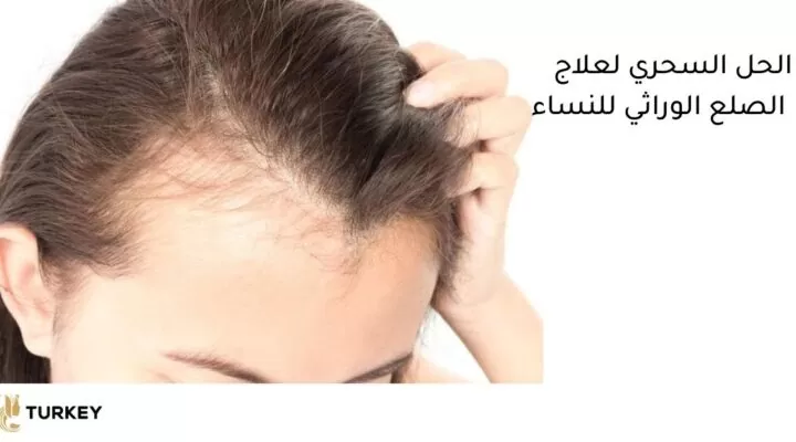 الصلع الوراثي عند النساء | أسبابه وأفضل طريقة لعلاجه نهائيًا