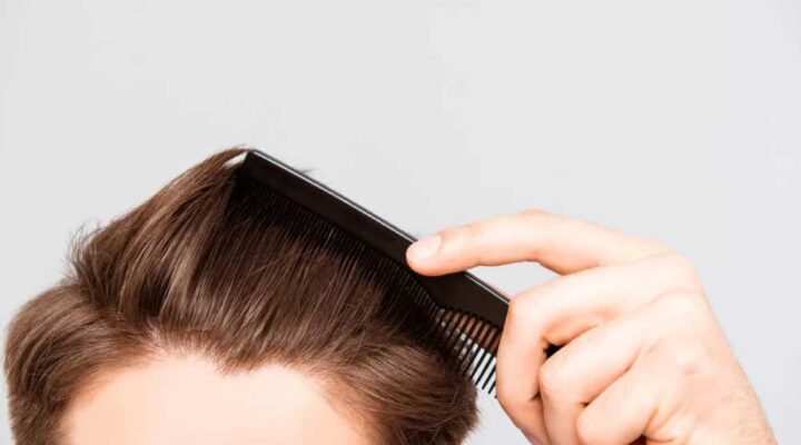 بعد عملية زراعة الشعر