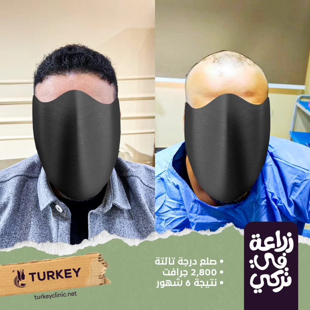 تجارب زراعة الشعر في مصر في مركز تركي هير