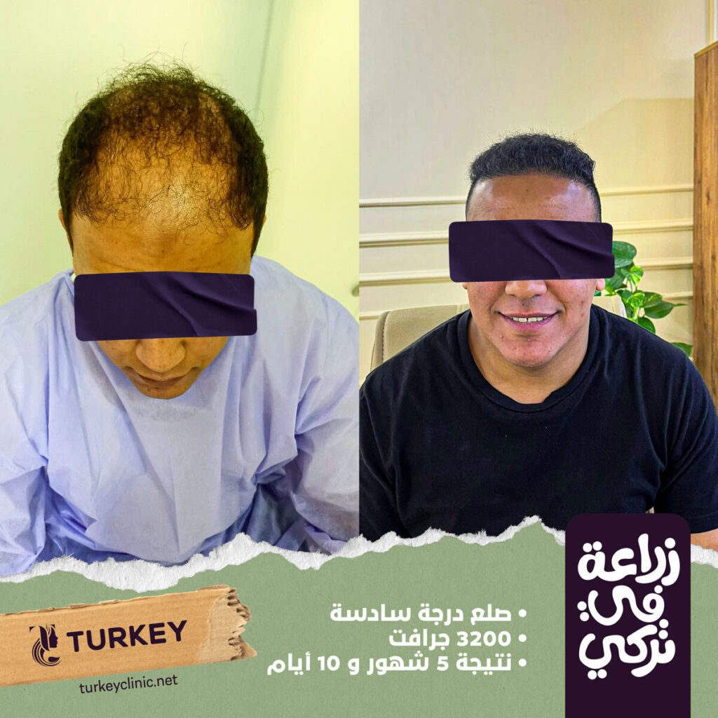 تجارب زراعة الشعر في مصر في مركز تركي هير
