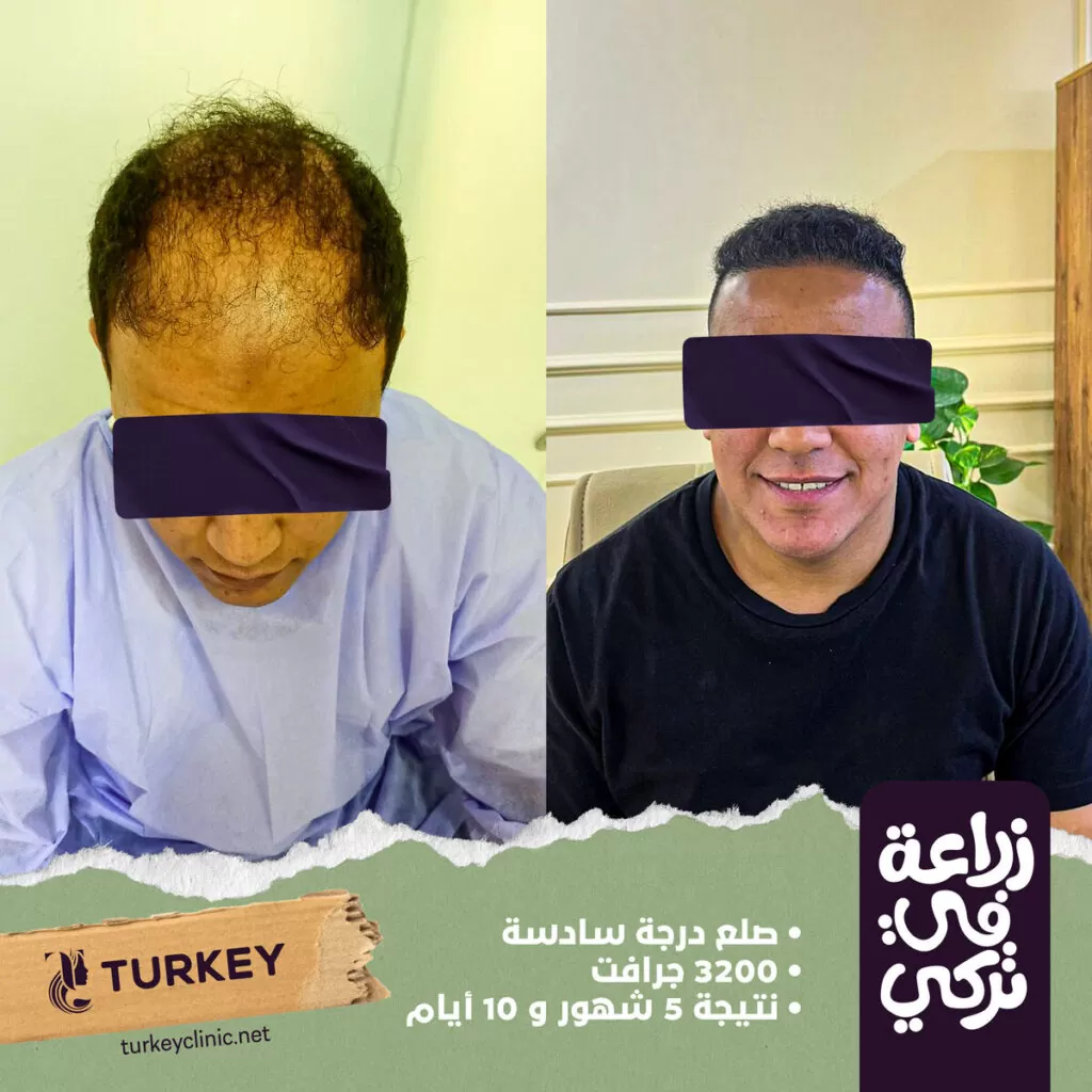 تجارب زراعة الشعر في مصر في مركز تركي هير