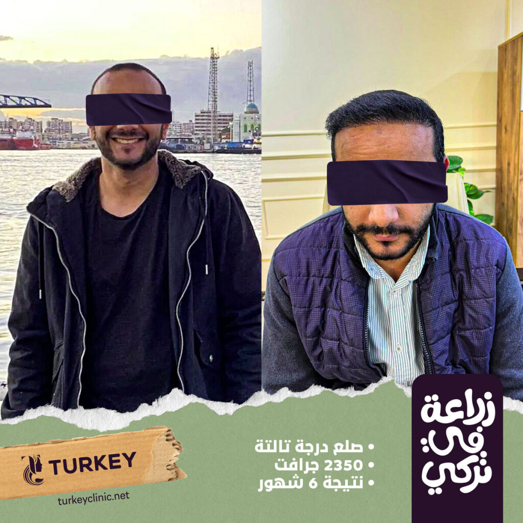 تجارب زراعة الشعر في مصر في مركز تركي هير