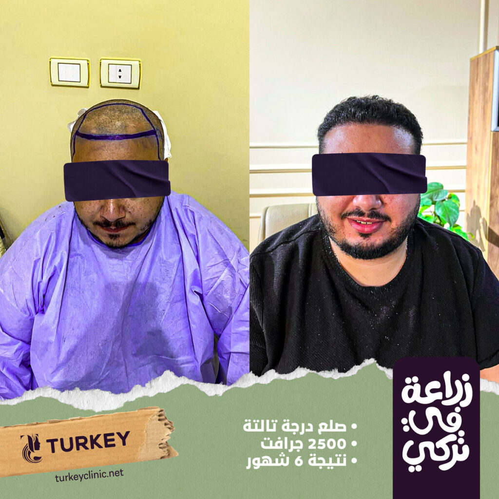 تجارب زراعة الشعر في مصر في مركز تركي هير