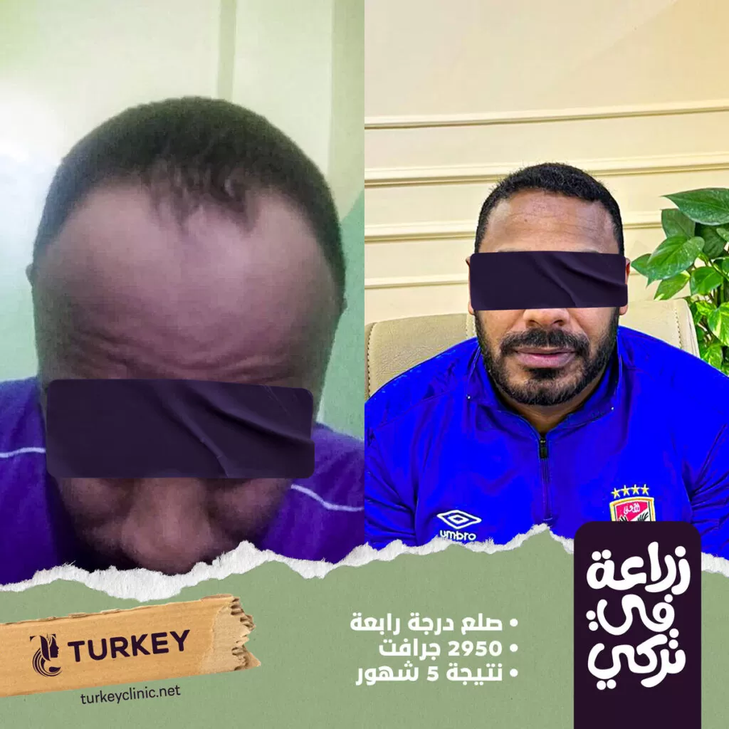 تجارب زراعة الشعر في مصر في مركز تركي هير