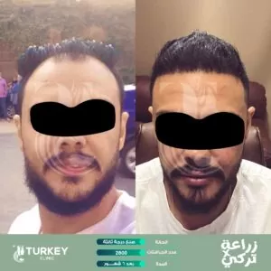 نتيجة زراعة الشعر في مصر في مركز تركي هير