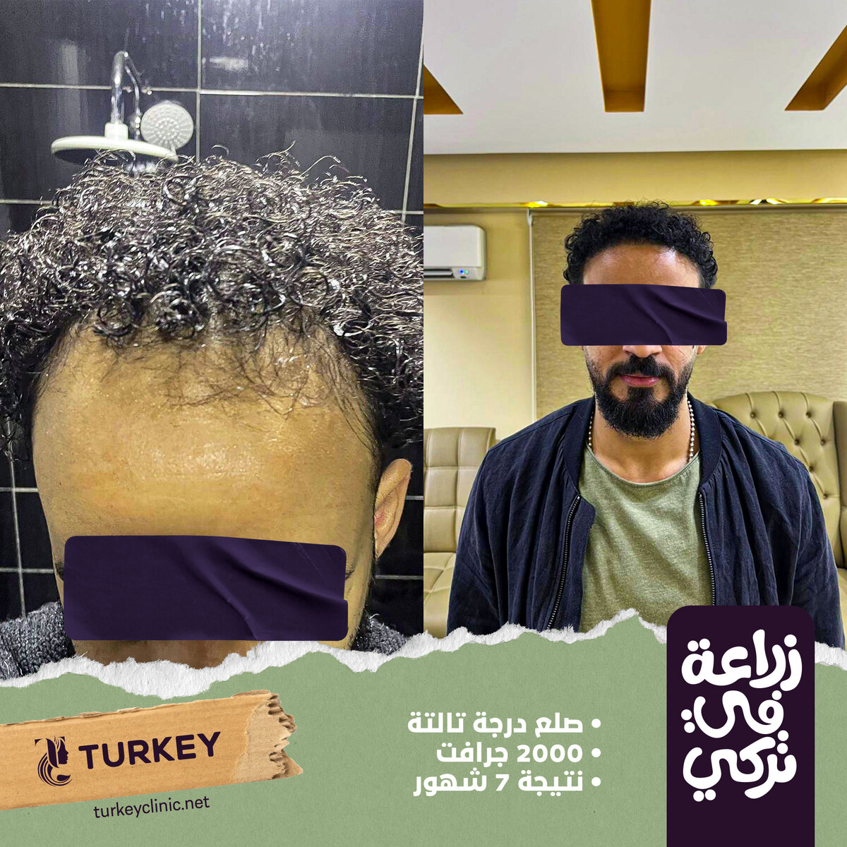 تجارب زراعة الشعر في مصر في مركز تركي هير