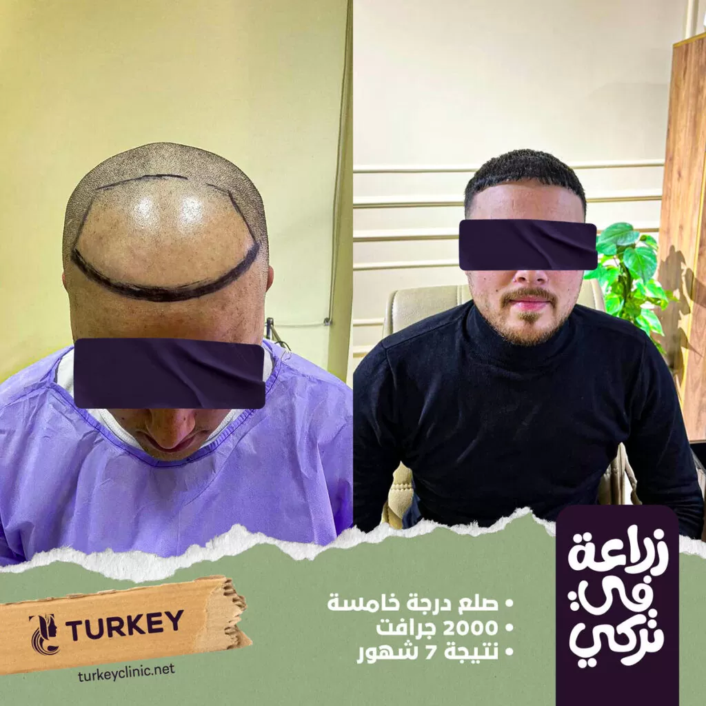 6 نصائح لزيادة نسبة نجاح عمليات زراعة الشعر 5 تجارب زراعة الشعر في مصر في مركز تركي هير