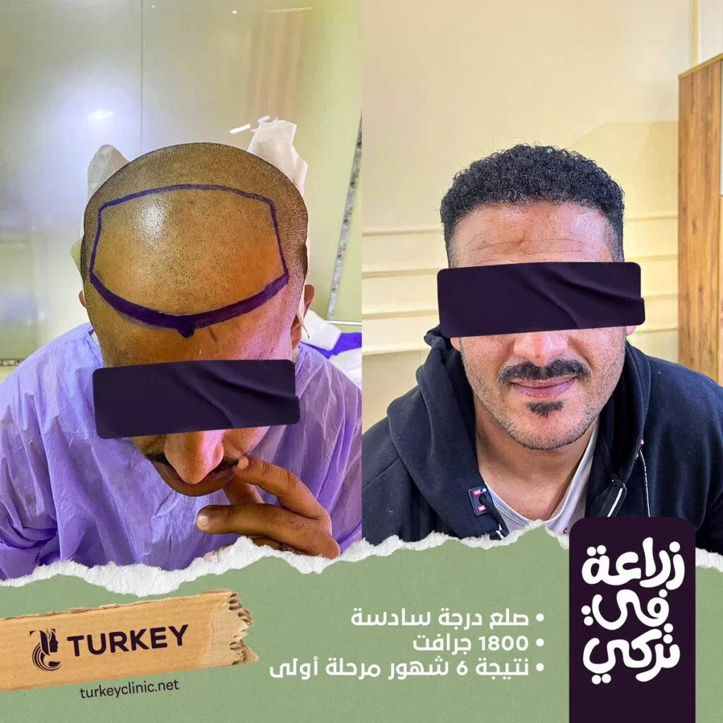 تجارب زراعة الشعر في مصر في مركز تركي هير