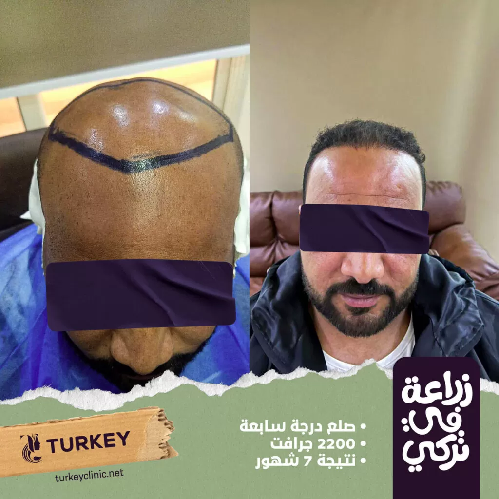 تجارب زراعة الشعر في مصر في مركز تركي هير