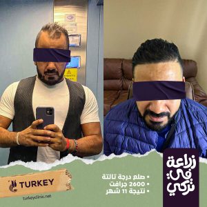 الممنوعات بعد زراعة الشعر | 17 أمر عليك تجنبهم 2 تجارب زراعة الشعر في مصر في مركز تركي هير
