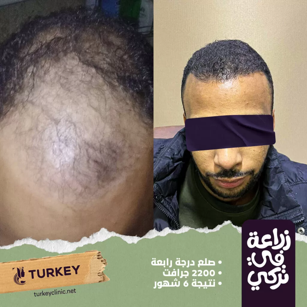 تجارب زراعة الشعر في مصر في مركز تركي هير
