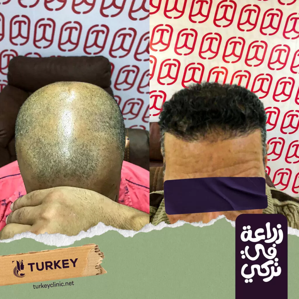 كيف تتم عملية زراعة الشعر وما هي مخاطرها؟ 6 تجارب زراعة الشعر في مصر في مركز تركي هير