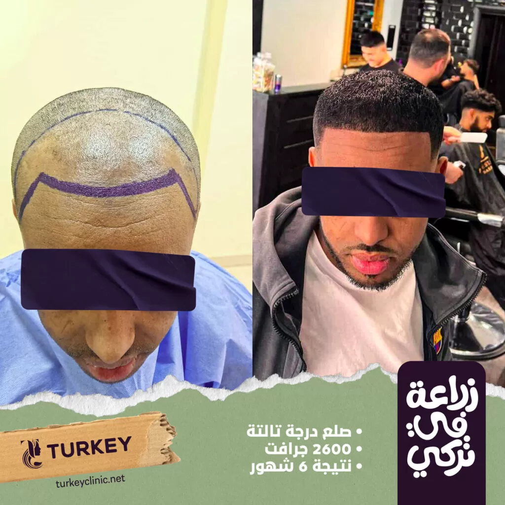 كيف تتم عملية زراعة الشعر وما هي مخاطرها؟ 8 تجارب زراعة الشعر في مصر في مركز تركي هير