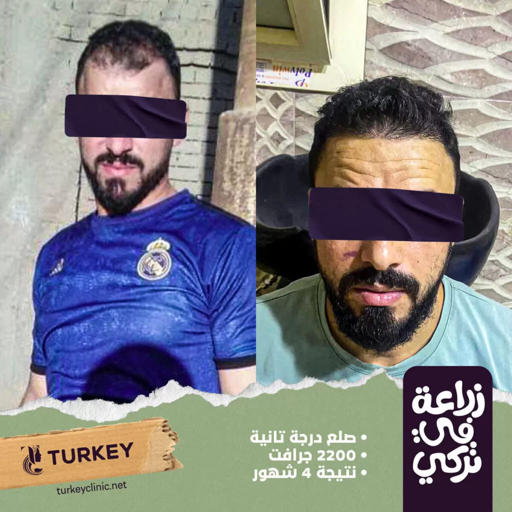 تجارب زراعة الشعر في مصر في مركز تركي هير