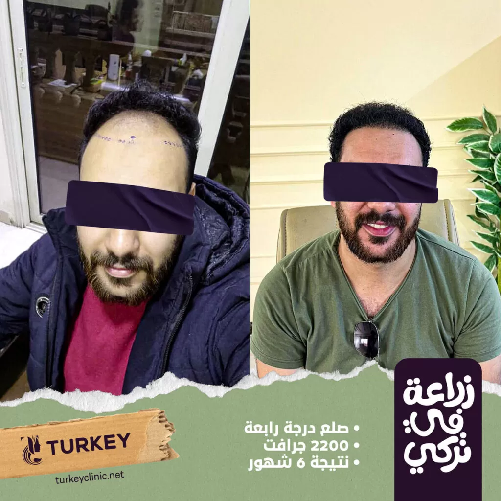 تجارب زراعة الشعر في مصر في مركز تركي هير