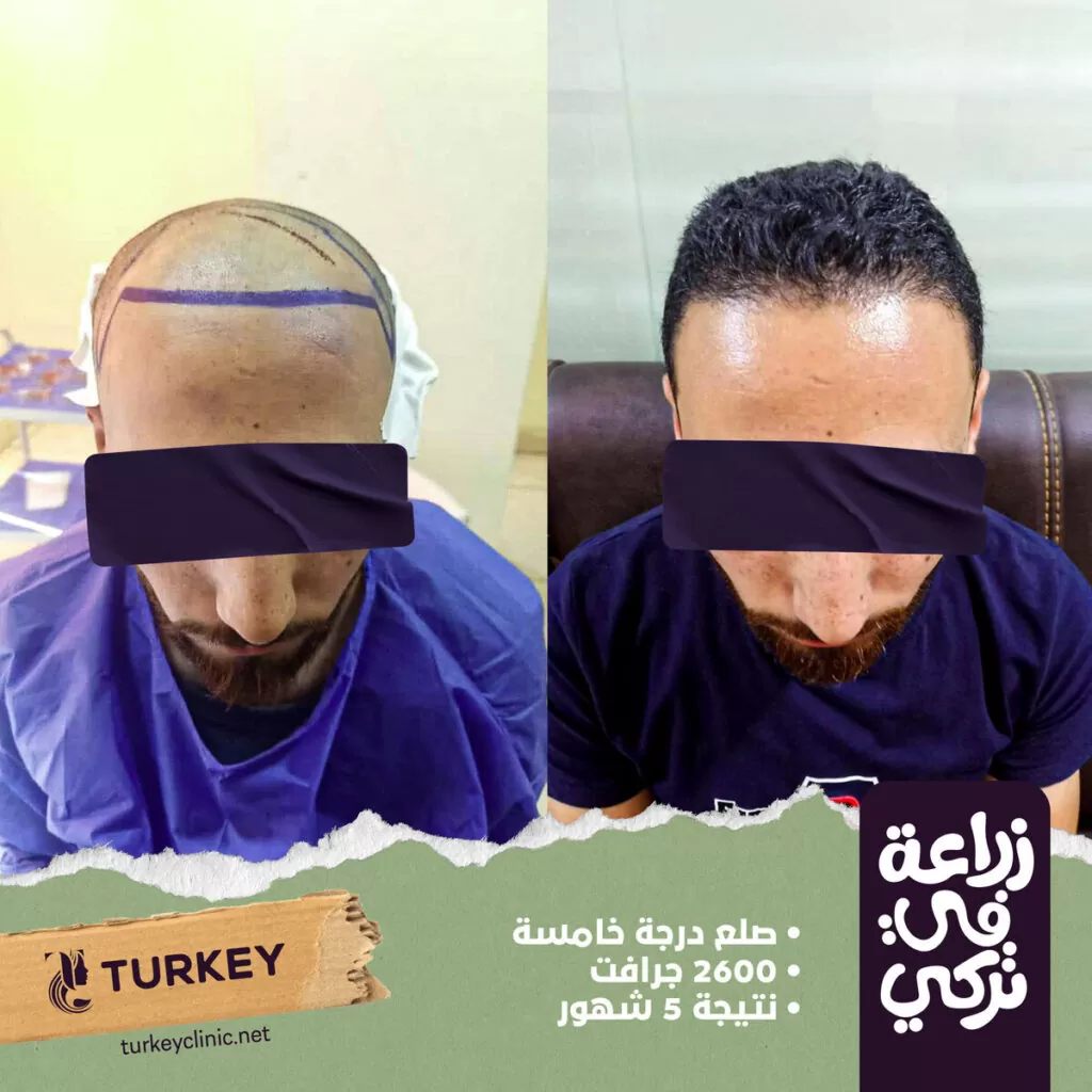 تجارب زراعة الشعر في مصر في مركز تركي هير
