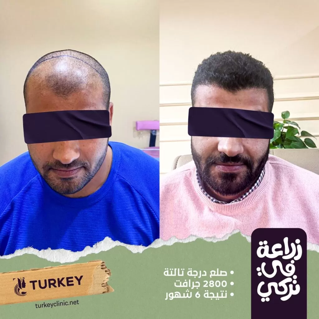 تجارب زراعة الشعر في مصر في مركز تركي هير