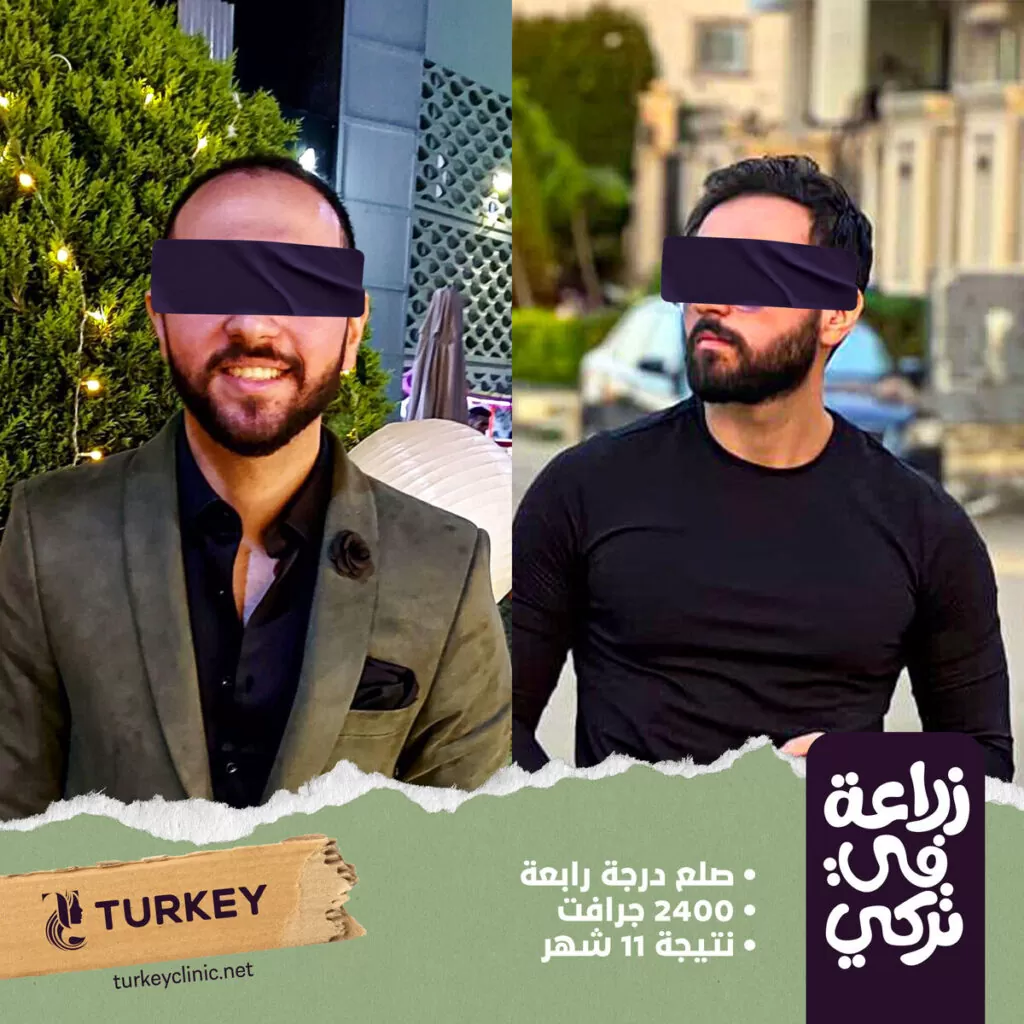 تجارب زراعة الشعر في مصر في مركز تركي هير