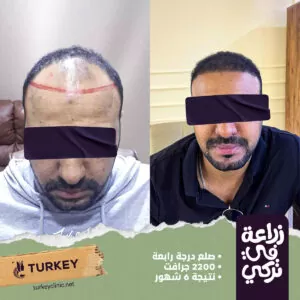تجارب زراعة الشعر في مصر في مركز تركي هير