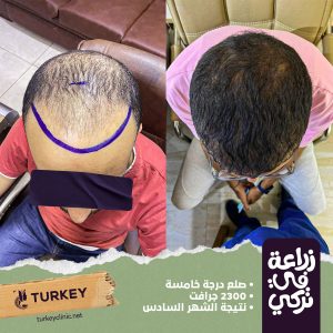 تجارب زراعة الشعر في مصر في مركز تركي هير