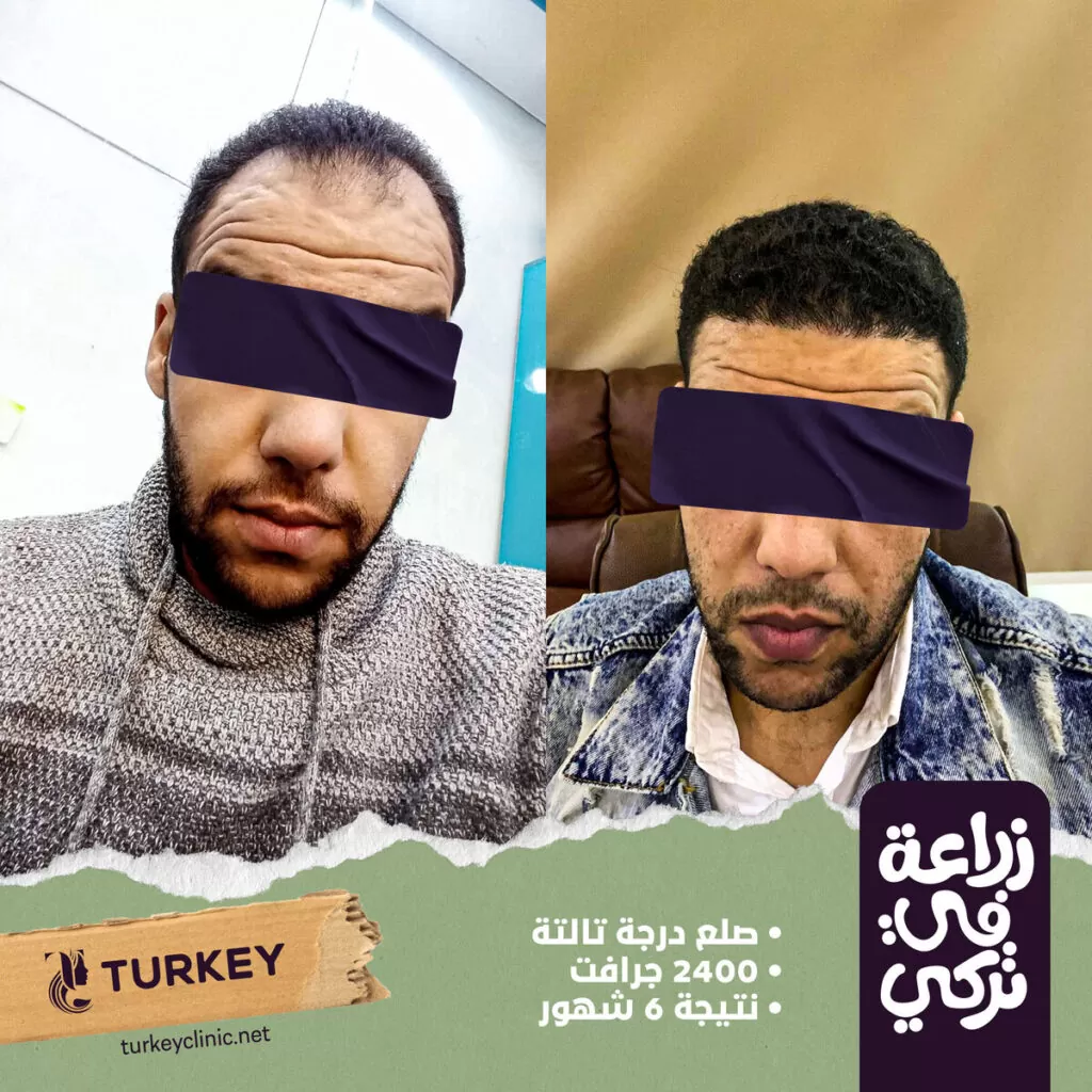 تجارب زراعة الشعر في مصر في مركز تركي هير