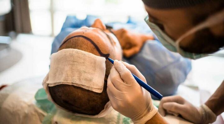تعليمات زراعة الشعر