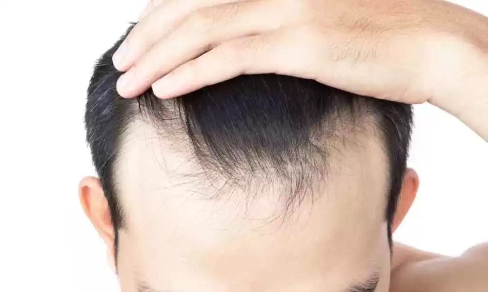 4 محددات لرسم خط الشعر الأمامي في زراعة الشعر 2 خط الشعر الأمامي