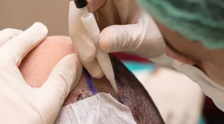 زرع الشعر بدون جراحة في 3 خطوات 14 زرع الشعر بدون جراحة
