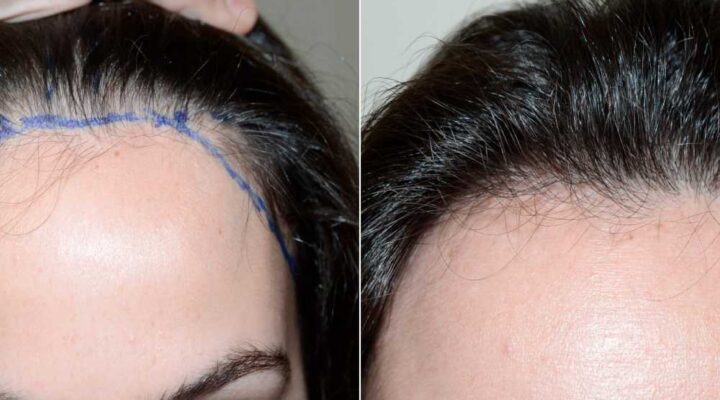 عمليات زراعة الشعر للسيدات