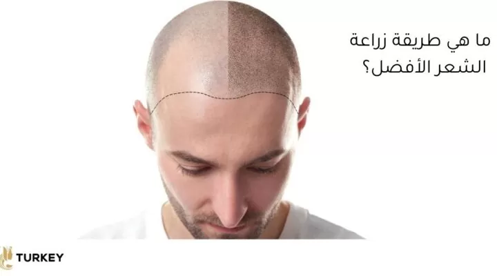 ما هي تقنية زراعة الشعر الأفضل؟