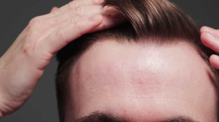 مدة عملية زراعة الشعر