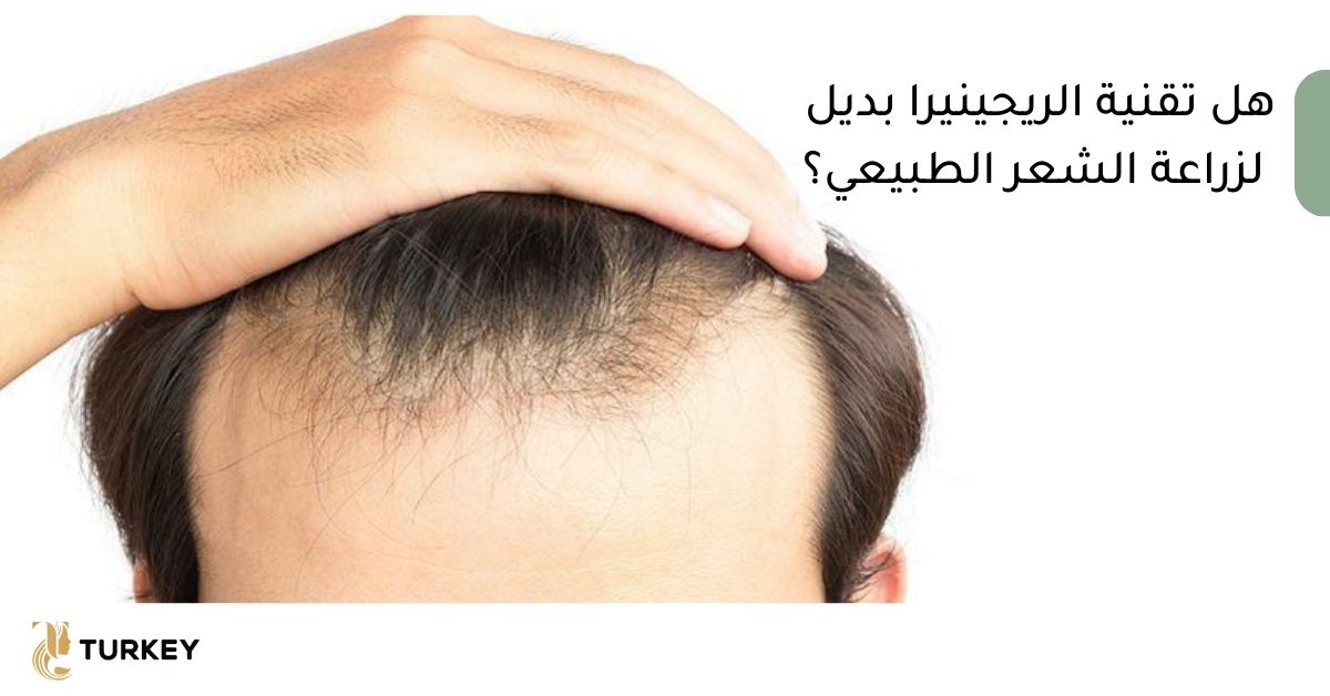 هل حقن الريجينيرا بديل لزراعة الشعر الطبيعي؟