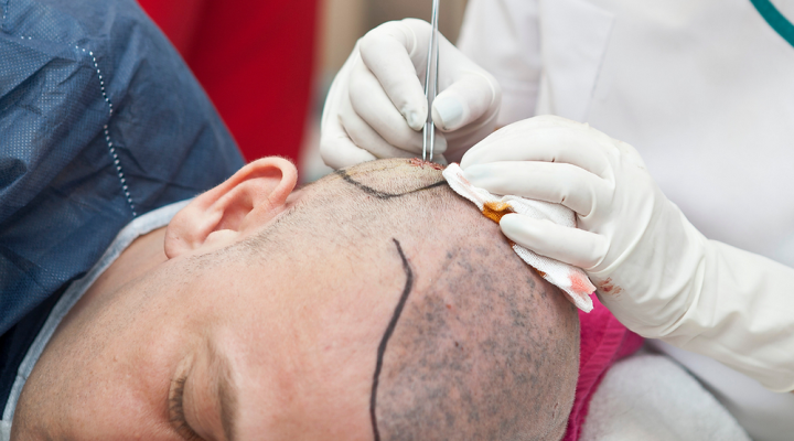 أحدث تقنيات زراعة الشعر